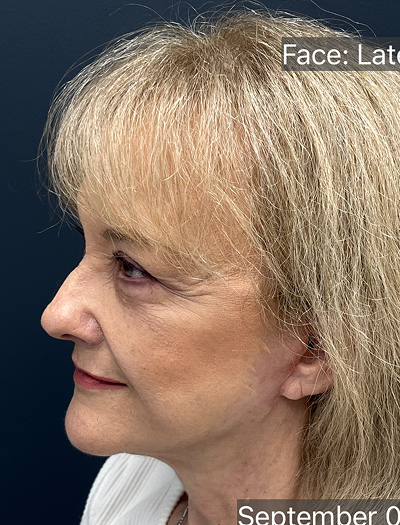 Facelift & Neck Lift 04 After Image