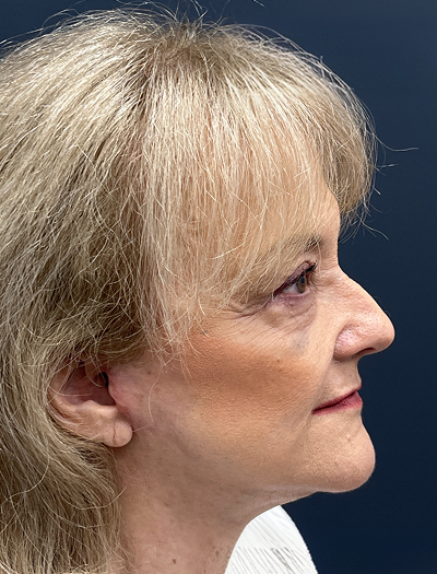 Facelift & Neck Lift 4 After Image