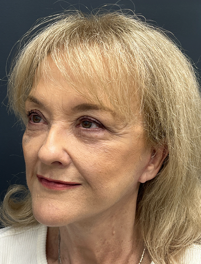 Facelift & Neck Lift 4 After Image