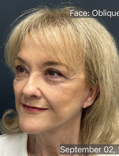 Facelift & Neck Lift 04 After Image