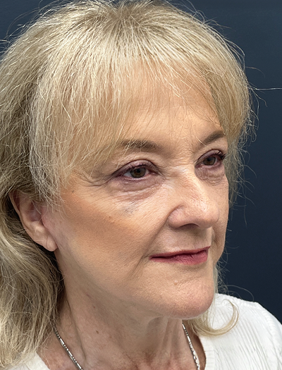 Facelift & Neck Lift 4 After Image