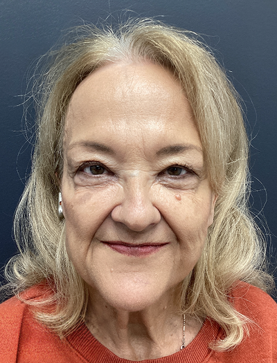 Facelift & Neck Lift 4 Before Image