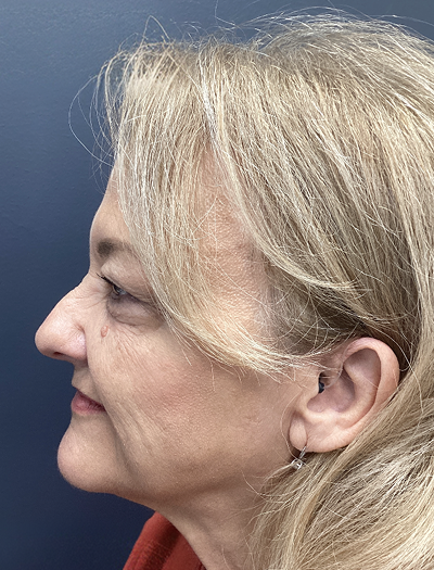 Facelift & Neck Lift 4 Before Image