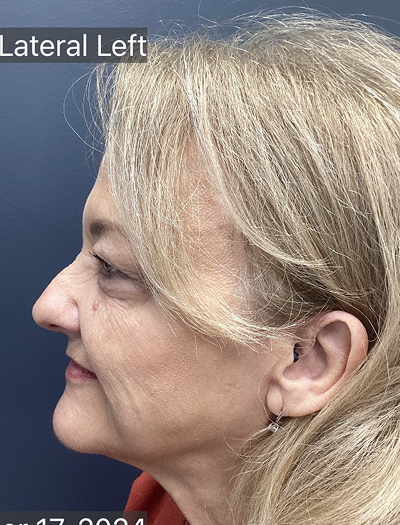 Facelift & Neck Lift 04 Before Image