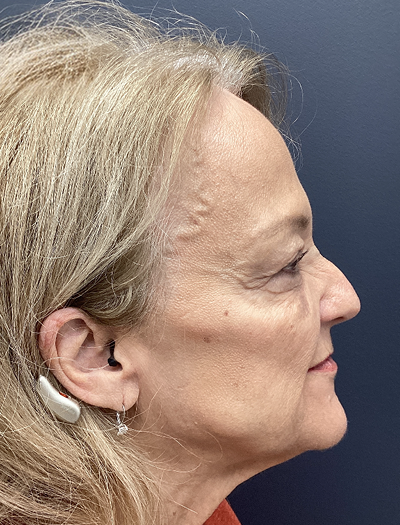 Facelift & Neck Lift 4 Before Image