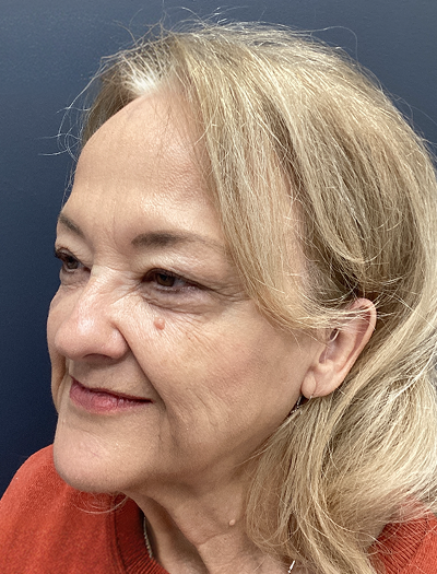 Facelift & Neck Lift 4 Before Image