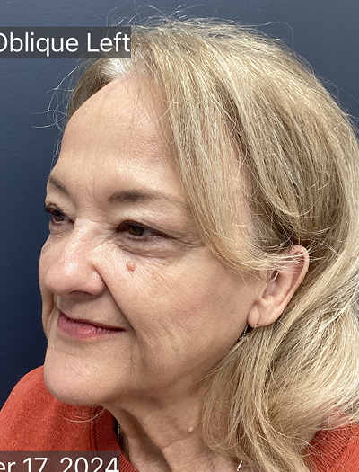 Facelift & Neck Lift 04 Before Image