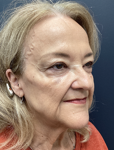 Facelift & Neck Lift 4 Before Image