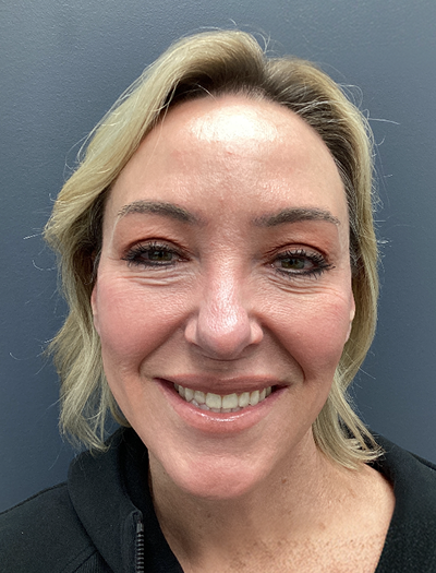 Facelift & Neck Lift 2 After Image