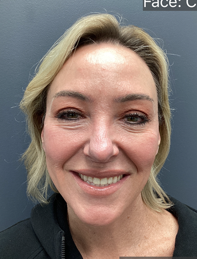 Facelift & Neck Lift 02 After Image