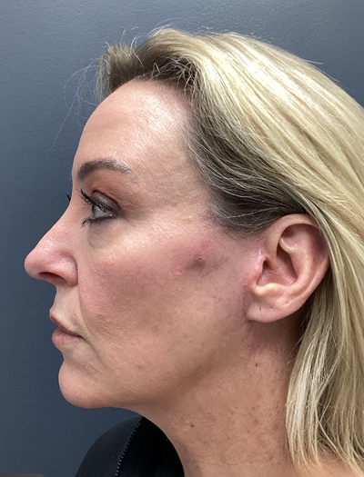 Facelift & Neck Lift 2 After Image
