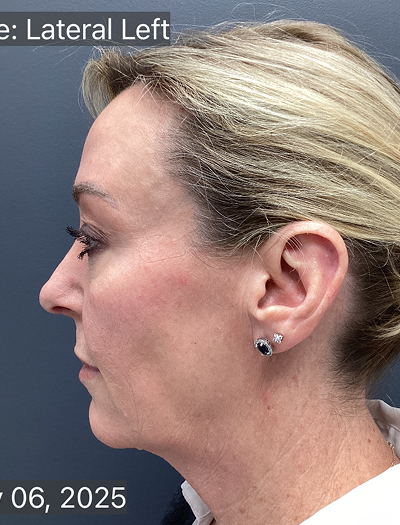 Facelift & Neck Lift 02 After Image