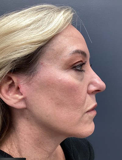 Facelift & Neck Lift 2 After Image