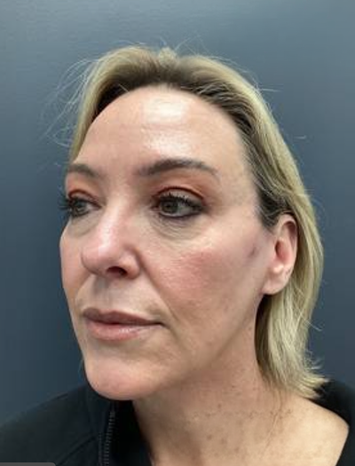Facelift & Neck Lift 2 After Image
