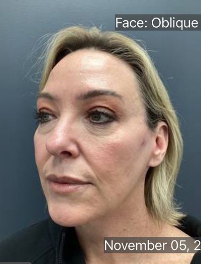 Facelift & Neck Lift 02 After Image