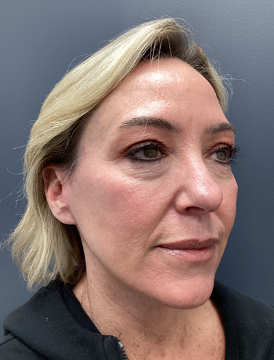 Facelift & Neck Lift 2 After Image