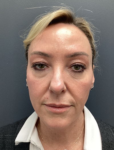 Facelift & Neck Lift 2 Before Image