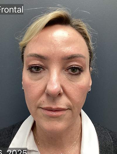 Facelift & Neck Lift 02 Before Image