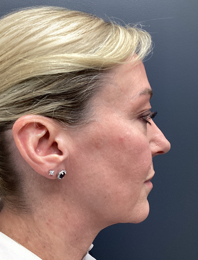 Facelift & Neck Lift 2 Before Image