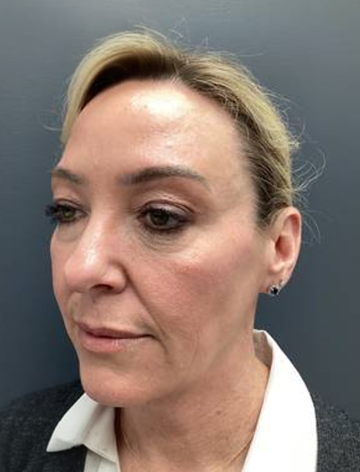 Facelift & Neck Lift 2 Before Image