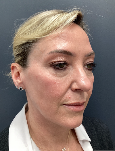 Facelift & Neck Lift 2 Before Image