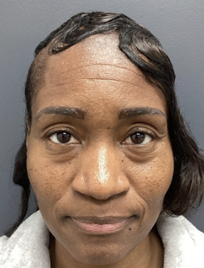 Botox 1 Before Image