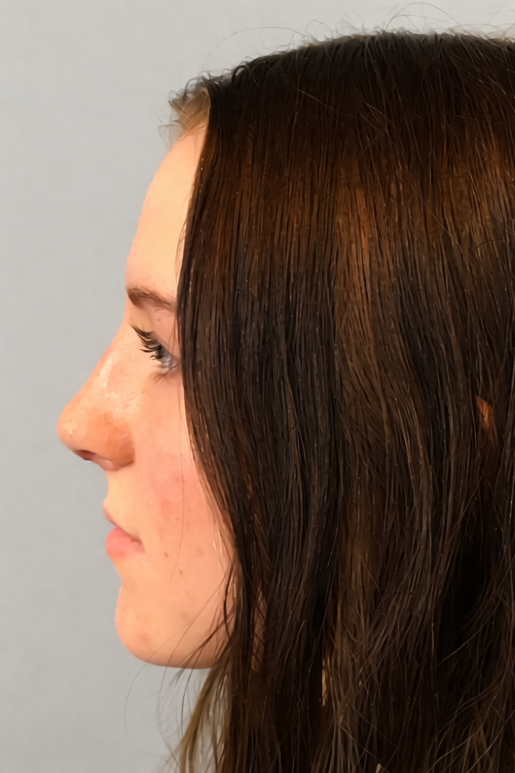 Rhinoplasty 3 After Image