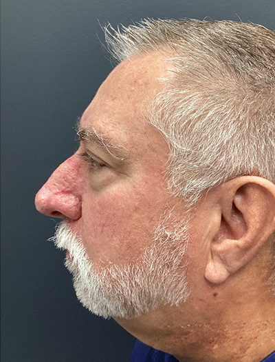 Rhinophyma 1 After Image