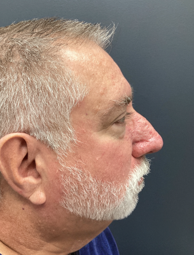 Rhinophyma 1 After Image