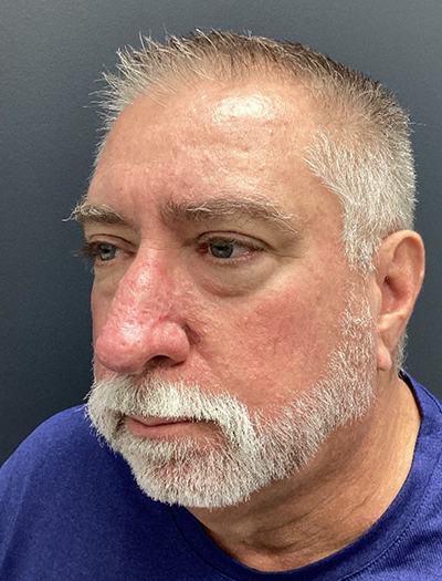 Rhinophyma 1 After Image