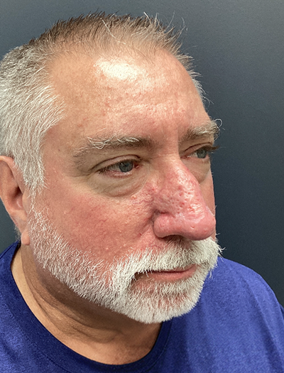 Rhinophyma 1 After Image