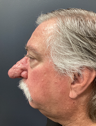 Rhinophyma 1 Before Image