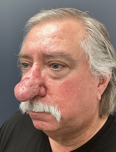 Rhinophyma 1 Before Image