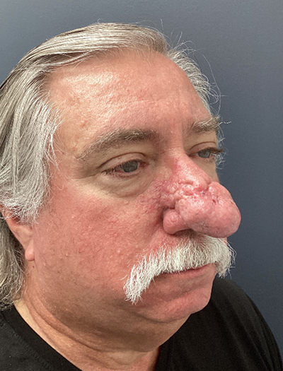 Rhinophyma 1 Before Image