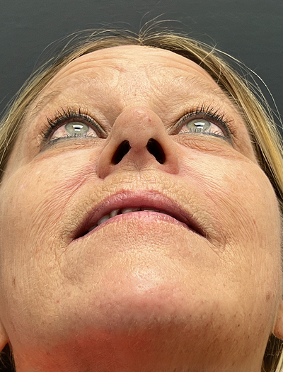 Rhinoplasty 1 After Image