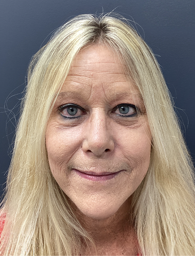 Rhinoplasty 1 After Image