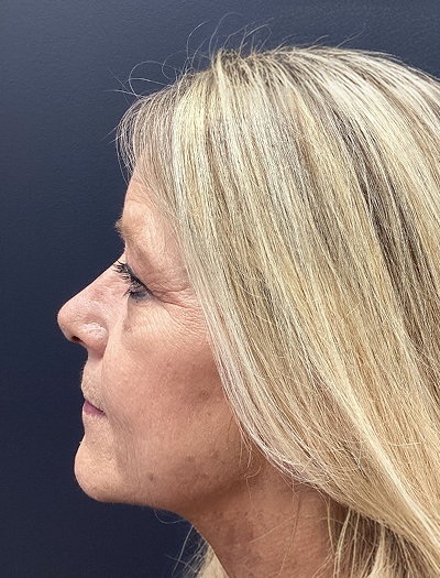 Rhinoplasty 1 After Image