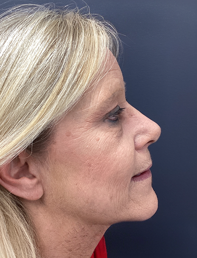 Rhinoplasty 1 After Image