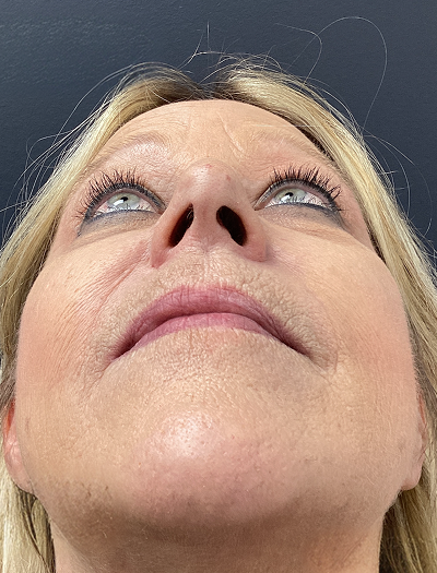 Rhinoplasty 1 Before Image