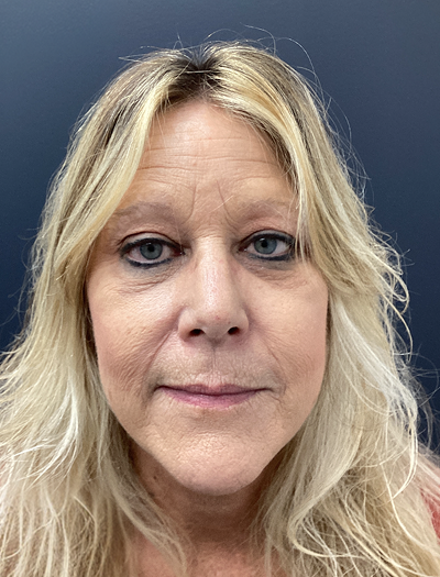 Rhinoplasty 1 Before Image