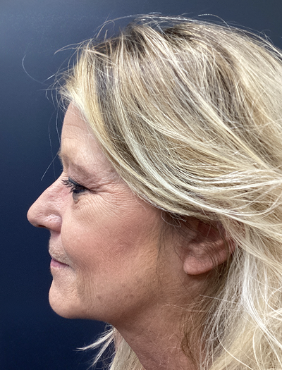 Rhinoplasty 1 Before Image