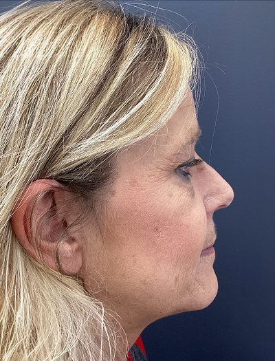 Rhinoplasty 1 Before Image