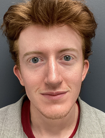 Rhinoplasty 2 After Image