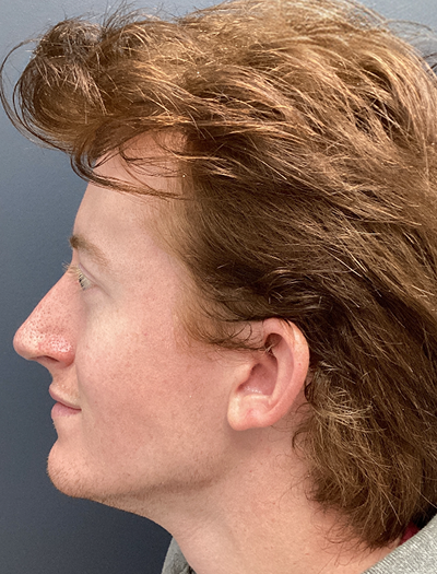 Rhinoplasty 2 After Image