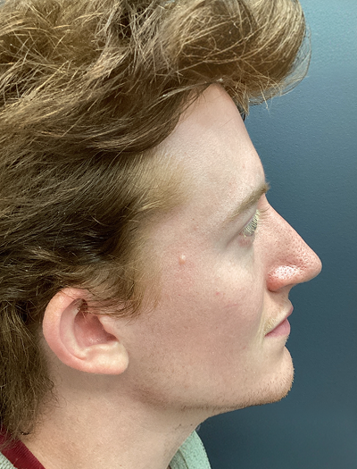 Rhinoplasty 2 After Image