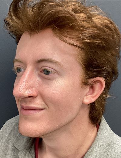 Rhinoplasty 2 After Image