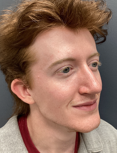 Rhinoplasty 2 After Image