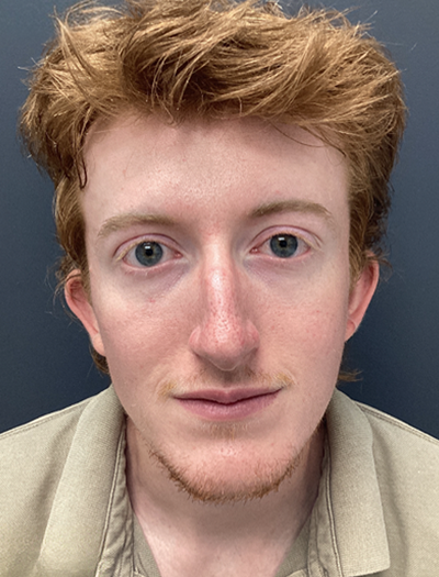 Rhinoplasty 2 Before Image