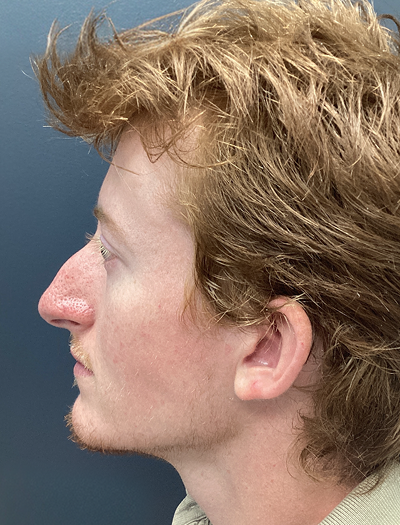 Rhinoplasty 2 Before Image