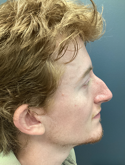 Rhinoplasty 2 Before Image